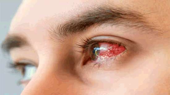 Outbreak of eye disease raises concerns in Colombo