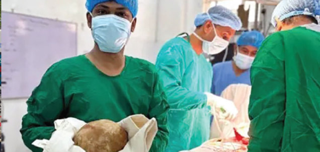 मूत्राशयबाट निकालियो ३.१ किलोको पत्थरी